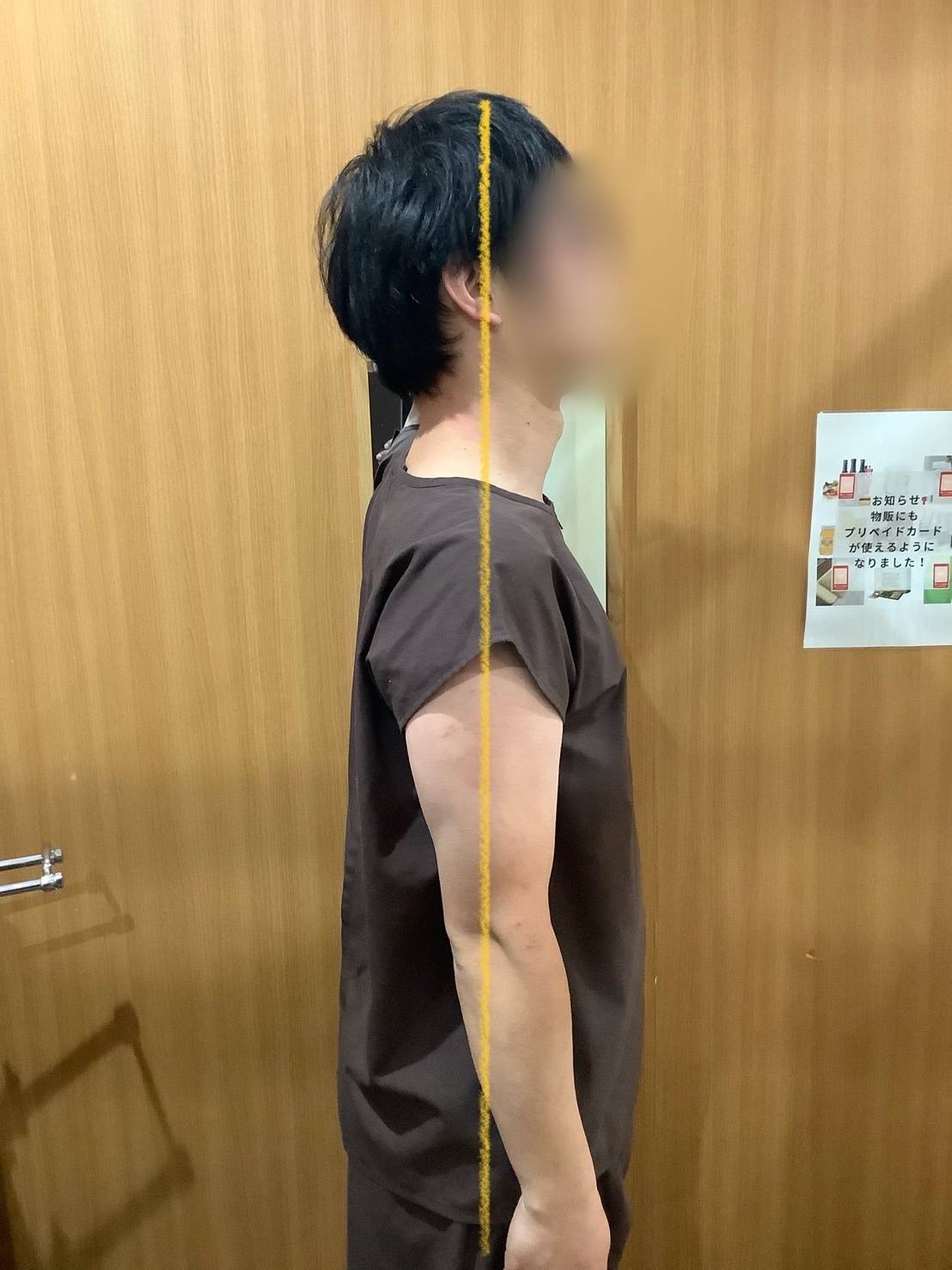 ストレートネック